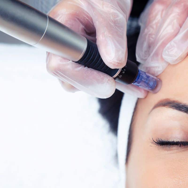 Morpheus8 treatment Wincanton from Lipo Sculpt - Book in today!