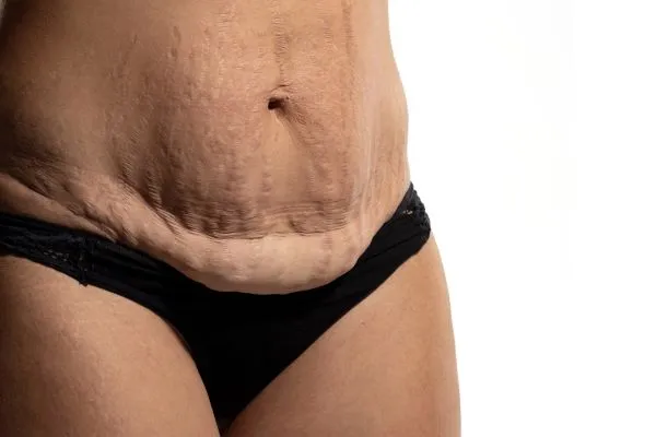 Lost the Weight but Not the Loose Skin? 1 image of womans stomach after weight loss showing loose skin Wincanton